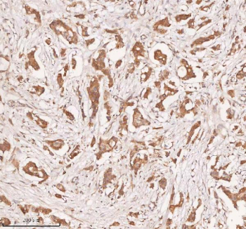 IHC analysis of SAMD9L using anti-SAMD9L antibody. SAMD9L was detected in a paraffin-embedded section of human breast cancer tissue. Heat mediated antigen retrieval was performed in EDTA buffer (pH 8.0, epitope retrieval solution). The tissue section was blocked with 10% goat serum. The tissue section was then incubated with 2 ug/ml rabbit anti-SAMD9L antibody overnight at 4oC. Peroxidase Conjugated Goat Anti-rabbit IgG was used as secondary antibody and incubated for 30 minutes at 37oC. The tissue section was developed using an HRP secondary and DAB substrate.