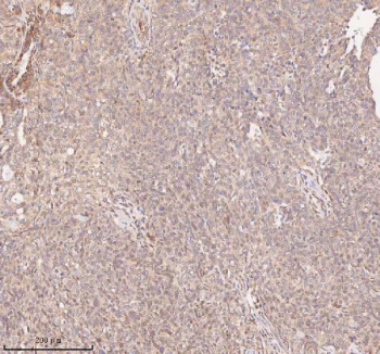 IHC analysis of SAMD9L using anti-SAMD9L antibody. SAMD9L was detected in a paraffin-embedded section of human cervix squamous cell carcinoma tissue. Heat mediated antigen retrieval was performed in EDTA buffer (pH 8.0, epitope retrieval solution). The tissue section was blocked with 10% goat serum. The tissue section was then incubated with 2 ug/ml rabbit anti-SAMD9L antibody overnight at 4oC. Peroxidase Conjugated Goat Anti-rabbit IgG was used as secondary antibody and incubated for 30 minutes at 37oC. The tissue section was developed using an HRP secondary and DAB substrate.