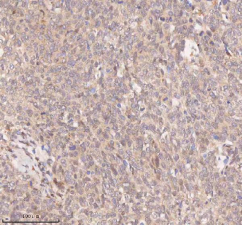 IHC analysis of SAMD9L using anti-SAMD9L antibody. SAMD9L was detected in a paraffin-embedded section of human cervix squamous cell carcinoma tissue. Heat mediated antigen retrieval was performed in EDTA buffer (pH 8.0, epitope retrieval solution). The tissue section was blocked with 10% goat serum. The tissue section was then incubated with 2 ug/ml rabbit anti-SAMD9L antibody overnight at 4oC. Peroxidase Conjugated Goat Anti-rabbit IgG was used as secondary antibody and incubated for 30 minutes at 37oC. The tissue section was developed using an HRP secondary and DAB substrate.
