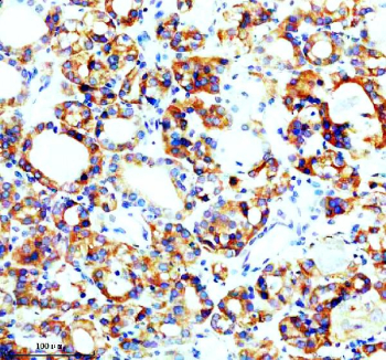 IHC analysis of SEC63 using anti-SEC63 antibody. SEC63 was detected in a paraffin-embedded section of human thyroid cancer tissue. Heat mediated antigen retrieval was performed in EDTA buffer (pH 8.0, epitope retrieval solution). The tissue section was blocked with 10% goat serum. The tissue section was then incubated with 2 ug/ml rabbit anti-SEC63 antibody overnight at 4oC. Peroxidase Conjugated Goat Anti-rabbit IgG was used as secondary antibody and incubated for 30 minutes at 37oC. The tissue section was developed using an HRP secondary and DAB substrate.