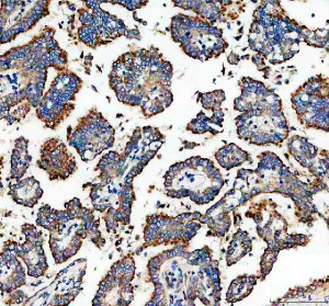 GALNT7 Antibody Human Lung Cancer IHC. Immunohistochemistry analysis of FFPE human lung cancer tissue using GALNT7 Antibody. Heat induced antigen retrieval was performed in pH 8.0 EDTA buffer prior to overnight incubation with primary antibody (2 ug/mL) at 4Â°C. Peroxidase-conjugated goat anti-rabbit IgG and DAB chromogen were used for visualization. Predominantly cytoplasmic staining with focal perinuclear enhancement is observed in malignant epithelial cells, consistent with the Golgi localization of GALNT7, an enzyme that initiates mucin-type O-linked glycosylation. These results support the use of GALNT7 Antibody / O-Glycosylation Enzyme Antibody for studying GALNT7 expression, protein O-glycosylation and cancer-associated glycosylation pathways.
