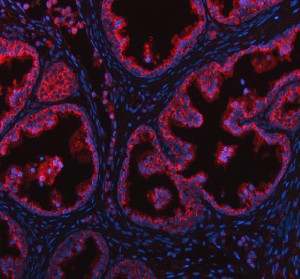 GALNT7 Antibody Human Prostate Cancer IF. Immunofluorescence analysis of FFPE human prostate cancer tissue using GALNT7 Antibody. Heat induced antigen retrieval was performed in pH 8.0 EDTA buffer prior to overnight incubation with primary antibody (5 ug/mL) at 4Â°C. Cy3-conjugated goat anti-rabbit IgG (red) was used for detection, and DAPI (blue) was used as a nuclear counterstain. Strong cytoplasmic staining with prominent perinuclear enrichment is observed in malignant glandular epithelial cells, consistent with the Golgi localization of GALNT7, an enzyme that initiates mucin-type O-linked glycosylation. These results support the use of GALNT7 Antibody / O-Glycosylation Enzyme Antibody for studying GALNT7 expression, Golgi organization and protein O-glycosylation.