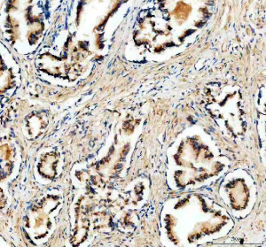 GALNT7 Antibody Human Prostate Cancer IHC. Immunohistochemistry analysis of FFPE human prostate cancer tissue using GALNT7 Antibody. Heat induced antigen retrieval was performed in pH 8.0 EDTA buffer prior to overnight incubation with primary antibody (2 ug/mL) at 4Â°C. Peroxidase-conjugated goat anti-rabbit IgG and DAB chromogen were used for visualization. Predominantly cytoplasmic staining with perinuclear enhancement is observed in malignant glandular epithelial cells, consistent with the Golgi localization of GALNT7, an enzyme that initiates mucin-type O-linked glycosylation. These results support the use of GALNT7 Antibody / O-Glycosylation Enzyme Antibody for studying GALNT7 expression, protein O-glycosylation and cancer-associated glycosylation pathways.
