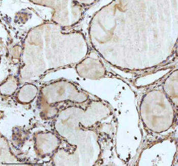 IHC analysis of IRF2BPL using anti-IRF2BPL antibody. IRF2BPL was detected in a paraffin-embedded section of follicles of human thyroid cancer tissue. Heat mediated antigen retrieval was performed in EDTA buffer (pH 8.0, epitope retrieval solution). The tissue section was blocked with 10% goat serum. The tissue section was then incubated with 2 ug/ml rabbit anti-IRF2BPL antibody overnight at 4oC. Peroxidase Conjugated Goat Anti-rabbit IgG was used as secondary antibody and incubated for 30 minutes at 37oC. The tissue section was developed using an HRP secondary and DAB substrate.