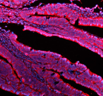IF analysis of UBE2A/UBE2B using anti-UBE2A/UBE2B antibody (red). UBE2A/UBE2B was detected in a paraffin-embedded section of human colon tissue. Heat mediated antigen retrieval was performed in EDTA buffer (pH 8.0, epitope retrieval solution). The tissue section was blocked with 10% goat serum. The tissue section was then incubated with 5 ug/ml rabbit anti-UBE2A/UBE2B antibody overnight at 4oC. Cy3 Conjugated Goat Anti-Rabbit IgG was used as secondary antibody at 1:500 dilution and incubated for 30 minutes at 37oC. The section was counterstained with DAPI (blue). Visualize using a fluorescence microscope and filter sets appropriate for the label used.
