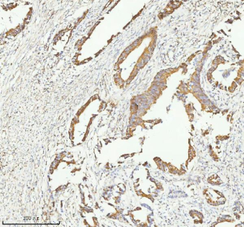 Immunohistochemical staining of HERPUD1 using anti-HERPUD1 antibody. HERPUD1 was detected in a paraffin-embedded section of human rectum adenocarcinoma tissue. Heat mediated antigen retrieval was performed in EDTA buffer (pH 8.0, epitope retrieval solution). The tissue section was blocked with 10% goat serum. The tissue section was then incubated with 2 ug/ml rabbit anti-HERPUD1 antibody overnight at 4oC. Peroxidase Conjugated Goat Anti-rabbit IgG was used as secondary antibody and incubated for 30 minutes at 37oC. The tissue section was developed using an HRP secondary and DAB substrate.