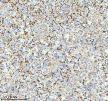 Immunohistochemical staining of HERPUD1 using anti-HERPUD1 antibody. HERPUD1 was detected in a paraffin-embedded section of human testicular seminoma tissue. Heat mediated antigen retrieval was performed in EDTA buffer (pH 8.0, epitope retrieval solution). The tissue section was blocked with 10% goat serum. The tissue section was then incubated with 2 ug/ml rabbit anti-HERPUD1 antibody overnight at 4oC. Peroxidase Conjugated Goat Anti-rabbit IgG was used as secondary antibody and incubated for 30 minutes at 37oC. The tissue section was developed using an HRP secondary and DAB substrate.