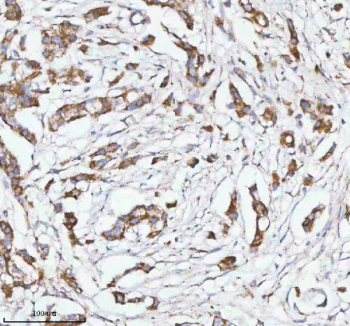 Immunohistochemical staining of HERPUD1 using anti-HERPUD1 antibody. HERPUD1 was detected in a paraffin-embedded section of human breast cancer tissue. Heat mediated antigen retrieval was performed in EDTA buffer (pH 8.0, epitope retrieval solution). The tissue section was blocked with 10% goat serum. The tissue section was then incubated with 2 ug/ml rabbit anti-HERPUD1 antibody overnight at 4oC. Peroxidase Conjugated Goat Anti-rabbit IgG was used as secondary antibody and incubated for 30 minutes at 37oC. The tissue section was developed using an HRP secondary and DAB substrate.