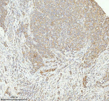 Immunohistochemical staining of HERPUD1 using anti-HERPUD1 antibody. HERPUD1 was detected in a paraffin-embedded section of human cervix squamous cell carcinoma tissue. Heat mediated antigen retrieval was performed in EDTA buffer (pH 8.0, epitope retrieval solution). The tissue section was blocked with 10% goat serum. The tissue section was then incubated with 2 ug/ml rabbit anti-HERPUD1 antibody overnight at 4oC. Peroxidase Conjugated Goat Anti-rabbit IgG was used as secondary antibody and incubated for 30 minutes at 37oC. The tissue section was developed using an HRP secondary and DAB substrate.