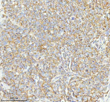 Immunohistochemical staining of HERPUD1 using anti-HERPUD1 antibody. HERPUD1 was detected in a paraffin-embedded section of human cervix squamous cell carcinoma tissue. Heat mediated antigen retrieval was performed in EDTA buffer (pH 8.0, epitope retrieval solution). The tissue section was blocked with 10% goat serum. The tissue section was then incubated with 2 ug/ml rabbit anti-HERPUD1 antibody overnight at 4oC. Peroxidase Conjugated Goat Anti-rabbit IgG was used as secondary antibody and incubated for 30 minutes at 37oC. The tissue section was developed using an HRP secondary and DAB substrate.