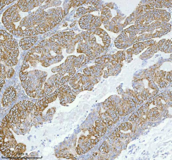 Immunohistochemical staining of HERPUD1 using anti-HERPUD1 antibody. HERPUD1 was detected in a paraffin-embedded section of human ovarian cancer tissue. Heat mediated antigen retrieval was performed in EDTA buffer (pH 8.0, epitope retrieval solution). The tissue section was blocked with 10% goat serum. The tissue section was then incubated with 2 ug/ml rabbit anti-HERPUD1 antibody overnight at 4oC. Peroxidase Conjugated Goat Anti-rabbit IgG was used as secondary antibody and incubated for 30 minutes at 37oC. The tissue section was developed using an HRP secondary and DAB substrate.
