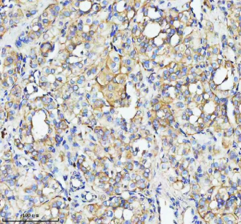 Immunohistochemical staining of TOM1 using anti-TOM1 antibody. TOM1 was detected in a paraffin-embedded section of human thyroid cancer tissue. Heat mediated antigen retrieval was performed in EDTA buffer (pH 8.0, epitope retrieval solution). The tissue section was blocked with 10% goat serum. The tissue section was then incubated with 2 ug/ml rabbit anti-TOM1 antibody overnight at 4oC. Peroxidase Conjugated Goat Anti-rabbit IgG was used as secondary antibody and incubated for 30 minutes at 37oC. The tissue section was developed using an HRP secondary and DAB substrate.