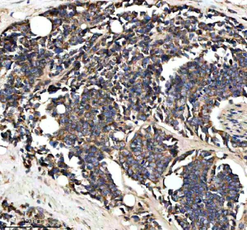 Immunohistochemical staining of PTCD3 using anti-PTCD3 antibody. PTCD3 was detected in a paraffin-embedded section of human colon cancer tissue. Heat mediated antigen retrieval was performed in EDTA buffer (pH 8.0, epitope retrieval solution). The tissue section was blocked with 10% goat serum. The tissue section was then incubated with 2 ug/ml rabbit anti-PTCD3 antibody overnight at 4oC. Peroxidase Conjugated Goat Anti-rabbit IgG was used as secondary antibody and incubated for 30 minutes at 37oC. The tissue section was developed using an HRP secondary and DAB substrate.