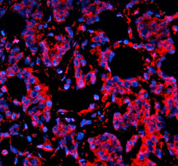 SORL1 Antibody Human Breast Cancer IF. Immunofluorescent staining of FFPE human breast cancer tissue with SORL1 antibody (red) demonstrated prominent cytoplasmic and membranous localization in malignant epithelial cells. SORL1 (Sortilin-Related Receptor 1) is a VPS10-domain sorting receptor that regulates intracellular protein trafficking, endosomal sorting, and receptor recycling, thereby maintaining cellular protein homeostasis. Altered SORL1 expression has been implicated in neurodegenerative disorders and several human cancers. Nuclei were counterstained with DAPI (blue). Heat-mediated antigen retrieval was performed in pH 8.0 EDTA buffer, followed by overnight incubation with SORL1 antibody at 5 ug/ml and detection using Cy3-conjugated goat anti-rabbit IgG.
