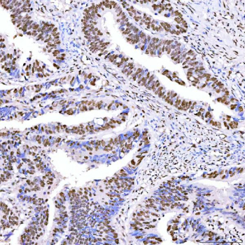 Immunohistochemical staining of SRRT using anti-SRRT antibody. SRRT was detected in a paraffin-embedded section of human endometrioid adenocarcinoma tissue. Heat mediated antigen retrieval was performed in EDTA buffer (pH 8.0, epitope retrieval solution). The tissue section was blocked with 10% goat serum. The tissue section was then incubated with 2 ug/ml rabbit anti-SRRT antibody overnight at 4oC. Peroxidase Conjugated Goat Anti-rabbit IgG was used as secondary antibody and incubated for 30 minutes at 37oC. The tissue section was developed using an HRP secondary and DAB substrate.