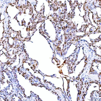 Immunohistochemical staining of SRRT using anti-SRRT antibody. SRRT was detected in a paraffin-embedded section of human ovary serous carcinoma tissue. Heat mediated antigen retrieval was performed in EDTA buffer (pH 8.0, epitope retrieval solution). The tissue section was blocked with 10% goat serum. The tissue section was then incubated with 2 ug/ml rabbit anti-SRRT antibody overnight at 4oC. Peroxidase Conjugated Goat Anti-rabbit IgG was used as secondary antibody and incubated for 30 minutes at 37oC. The tissue section was developed using an HRP secondary and DAB substrate.