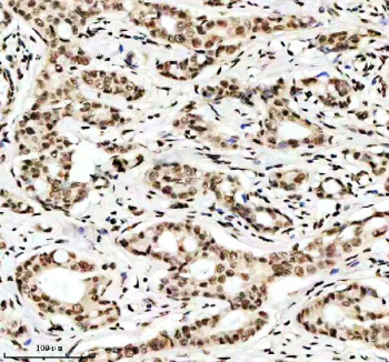 H3K9ac Antibody / HIST1H3A Transcriptional Priming Chromatin Antibody (clone 32H22). Immunohistochemistry analysis of HIST1H3A / Histone H3 Lys9 acetylation in human breast cancer tissue using H3K9ac Antibody / HIST1H3A Transcriptional Priming Chromatin Antibody. Strong HRP-DAB brown nuclear staining is observed in tumor epithelial cells, consistent with euchromatic localization and transcriptionally primed chromatin states associated with early gene activation, while surrounding stromal cells show lower nuclear signal.