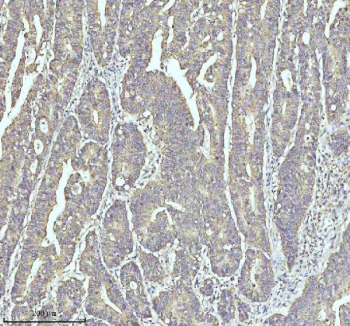Immunohistochemical staining of MYH14 using anti-MYH14 antibody. MYH14 was detected in a paraffin-embedded section of human colon cancer tissue. Heat mediated antigen retrieval was performed in EDTA buffer (pH 8.0, epitope retrieval solution). The tissue section was blocked with 10% goat serum. The tissue section was then incubated with 2 ug/ml rabbit anti-MYH14 antibody overnight at 4oC. Peroxidase Conjugated Goat Anti-rabbit IgG was used as secondary antibody and incubated for 30 minutes at 37oC. The tissue section was developed using an HRP secondary and DAB substrate.