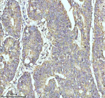 Immunohistochemical staining of MYH14 using anti-MYH14 antibody. MYH14 was detected in a paraffin-embedded section of human colon cancer tissue. Heat mediated antigen retrieval was performed in EDTA buffer (pH 8.0, epitope retrieval solution). The tissue section was blocked with 10% goat serum. The tissue section was then incubated with 2 ug/ml rabbit anti-MYH14 antibody overnight at 4oC. Peroxidase Conjugated Goat Anti-rabbit IgG was used as secondary antibody and incubated for 30 minutes at 37oC. The tissue section was developed using an HRP secondary and DAB substrate.