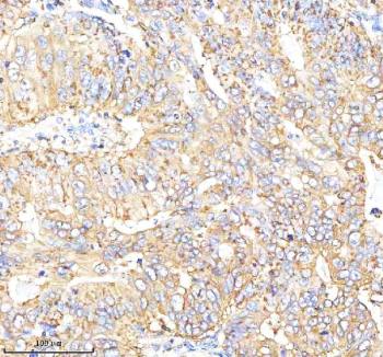 CGA Antibody Rabbit Polyclonal Stomach Cancer IHC. Immunohistochemical staining of Choriogonadotropin alpha/CGA using anti-CGA antibody rabbit polyclonal. Choriogonadotropin alpha/CGA was detected in a paraffin-embedded section of human stomach cancer tissue. Heat mediated antigen retrieval was performed in EDTA buffer (pH 8.0, epitope retrieval solution). The tissue section was blocked with 10% goat serum. The tissue section was then incubated with 2 ug/ml rabbit anti-CGA antibody overnight at 4oC. Peroxidase Conjugated Goat Anti-rabbit IgG was used as secondary antibody and incubated for 30 minutes at 37oC. The tissue section was developed using an HRP secondary and DAB substrate.