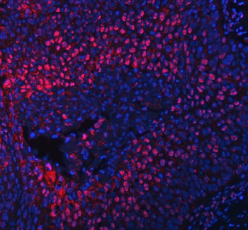 Immunofluorescent staining of RLIM using anti-RLIM antibody (red). RLIM was detected in a paraffin-embedded section of human esophageal squamous carcinoma tissue. Heat mediated antigen retrieval was performed in EDTA buffer (pH 8.0, epitope retrieval solution). The tissue section was blocked with 10% goat serum. The tissue section was then incubated with 5 ug/ml rabbit anti-RLIM antibody overnight at 4oC. DyLight 550 Conjugated Goat Anti-Rabbit IgG was used as secondary antibody at 1:500 dilution and incubated for 30 minutes at 37oC. The section was counterstained with DAPI nuclear stain (blue). Visualize using a fluorescence microscope and filter sets appropriate for the label used.