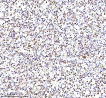 Immunohistochemical staining of RLIM using anti-RLIM antibody. RLIM was detected in a paraffin-embedded section of diffuse large B-cell lymphoma of human intestine tissue. Heat mediated antigen retrieval was performed in EDTA buffer (pH 8.0, epitope retrieval solution). The tissue section was blocked with 10% goat serum. The tissue section was then incubated with 2 ug/ml rabbit anti-RLIM antibody overnight at 4oC. Peroxidase Conjugated Goat Anti-rabbit IgG was used as secondary antibody and incubated for 30 minutes at 37oC. The tissue section was developed using an HRP secondary and DAB substrate.