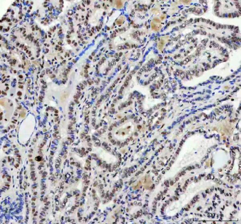 Immunohistochemical staining of FAM50A using anti-FAM50A antibody. FAM50A was detected in a paraffin-embedded section of human thyroid cancer tissue. Heat mediated antigen retrieval was performed in EDTA buffer (pH 8.0, epitope retrieval solution). The tissue section was blocked with 10% goat serum. The tissue section was then incubated with 1:50 rabbit anti-FAM50A antibody overnight at 4oC. Peroxidase Conjugated Goat Anti-rabbit IgG was used as secondary antibody and incubated for 30 minutes at 37oC. The tissue section was developed using an HRP secondary and DAB substrate.