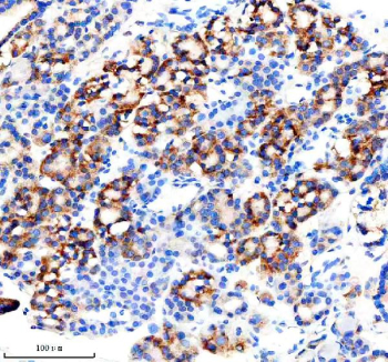 Immunohistochemical staining of MINPP1 using anti-MINPP1 antibody. MINPP1 was detected in a paraffin-embedded section of human thyroid cancer tissue. Heat mediated antigen retrieval was performed in EDTA buffer (pH 8.0, epitope retrieval solution). The tissue section was blocked with 10% goat serum. The tissue section was then incubated with 2 ug/ml rabbit anti-MINPP1 antibody overnight at 4oC. Peroxidase Conjugated Goat Anti-rabbit IgG was used as secondary antibody and incubated for 30 minutes at 37oC. The tissue section was developed using an HRP secondary and DAB substrate.