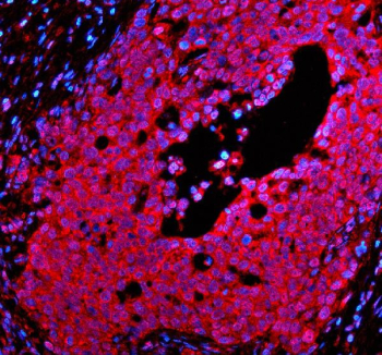 Immunofluorescent staining of PSMD1 using anti-PSMD1 antibody. PSMD1 was detected in a paraffin-embedded section of human ovarian cancer tissue. Heat mediated antigen retrieval was performed in EDTA buffer (pH 8.0, epitope retrieval solution). The tissue section was blocked with 10% goat serum. The tissue section was then incubated with 5 ug/ml rabbit anti-PSMD1 antibody overnight at 4oC. Cy3 Conjugated Goat Anti-Rabbit IgG was used as secondary antibody at 1:500 dilution and incubated for 30 minutes at 37oC. The section was counterstained with DAPI nuclear stain (blue). Visualize using a fluorescence microscope and filter sets appropriate for the label used.