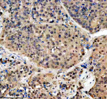 Immunohistochemical staining of PSMD1 using anti-PSMD1 antibody. PSMD1 was detected in a paraffin-embedded section of human liver cancer tissue. Heat mediated antigen retrieval was performed in EDTA buffer (pH 8.0, epitope retrieval solution). The tissue section was blocked with 10% goat serum. The tissue section was then incubated with 2 ug/ml rabbit anti-PSMD1 antibody overnight at 4oC. Peroxidase Conjugated Goat Anti-rabbit IgG was used as secondary antibody and incubated for 30 minutes at 37oC. The tissue section was developed using an HRP secondary and DAB substrate.