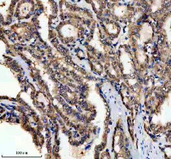 Immunohistochemical staining of PSMD1 using anti-PSMD1 antibody. PSMD1 was detected in a paraffin-embedded section of human thyroid cancer tissue. Heat mediated antigen retrieval was performed in EDTA buffer (pH 8.0, epitope retrieval solution). The tissue section was blocked with 10% goat serum. The tissue section was then incubated with 2 ug/ml rabbit anti-PSMD1 antibody overnight at 4oC. Peroxidase Conjugated Goat Anti-rabbit IgG was used as secondary antibody and incubated for 30 minutes at 37oC. The tissue section was developed using an HRP secondary and DAB substrate.