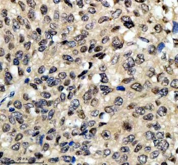 Immunohistochemical staining of PSMD1 using anti-PSMD1 antibody. PSMD1 was detected in a paraffin-embedded section of human cervical cancer tissue. Heat mediated antigen retrieval was performed in EDTA buffer (pH 8.0, epitope retrieval solution). The tissue section was blocked with 10% goat serum. The tissue section was then incubated with 2 ug/ml rabbit anti-PSMD1 antibody overnight at 4oC. Peroxidase Conjugated Goat Anti-rabbit IgG was used as secondary antibody and incubated for 30 minutes at 37oC. The tissue section was developed using an HRP secondary and DAB substrate.