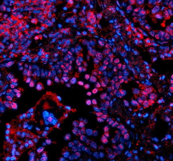 Immunofluorescent staining of PSMD1 using anti-PSMD1 antibody. PSMD1 was detected in a paraffin-embedded section of human lung cancer tissue. Heat mediated antigen retrieval was performed in EDTA buffer (pH 8.0, epitope retrieval solution). The tissue section was blocked with 10% goat serum. The tissue section was then incubated with 5 ug/ml rabbit anti-PSMD1 antibody overnight at 4oC. Cy3 Conjugated Goat Anti-Rabbit IgG was used as secondary antibody at 1:500 dilution and incubated for 30 minutes at 37oC. The section was counterstained with DAPI nuclear stain (blue). Visualize using a fluorescence microscope and filter sets appropriate for the label used.