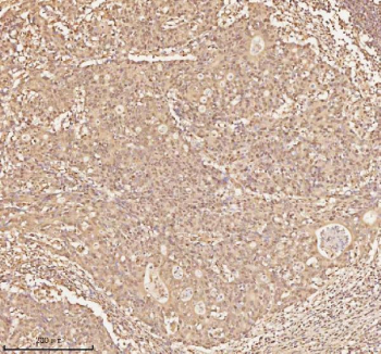 Immunohistochemical staining of NUP43 using anti-NUP43 antibody. NUP43 was detected in a paraffin-embedded section of human colon adenocarcinoma tissue. Heat mediated antigen retrieval was performed in EDTA buffer (pH 8.0, epitope retrieval solution). The tissue section was blocked with 10% goat serum. The tissue section was then incubated with 2 ug/ml rabbit anti-NUP43 antibody overnight at 4oC. Peroxidase Conjugated Goat Anti-rabbit IgG was used as secondary antibody and incubated for 30 minutes at 37oC. The tissue section was developed using an HRP secondary and DAB substrate.