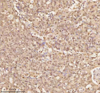 Immunohistochemical staining of NUP43 using anti-NUP43 antibody. NUP43 was detected in a paraffin-embedded section of human colon adenocarcinoma tissue. Heat mediated antigen retrieval was performed in EDTA buffer (pH 8.0, epitope retrieval solution). The tissue section was blocked with 10% goat serum. The tissue section was then incubated with 2 ug/ml rabbit anti-NUP43 antibody overnight at 4oC. Peroxidase Conjugated Goat Anti-rabbit IgG was used as secondary antibody and incubated for 30 minutes at 37oC. The tissue section was developed using an HRP secondary and DAB substrate.