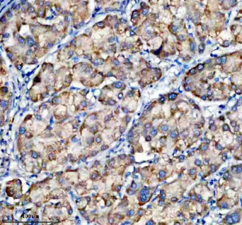 Immunohistochemical staining of TRIM10 using anti-TRIM10 antibody. TRIM10 was detected in a paraffin-embedded section of human liver cancer tissue. Heat mediated antigen retrieval was performed in EDTA buffer (pH 8.0, epitope retrieval solution). The tissue section was blocked with 10% goat serum. The tissue section was then incubated with 2 ug/ml rabbit anti-TRIM10 antibody overnight at 4oC. Peroxidase Conjugated Goat Anti-rabbit IgG was used as secondary antibody and incubated for 30 minutes at 37oC. The tissue section was developed using an HRP secondary and DAB substrate.