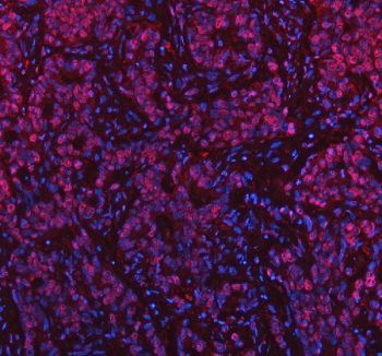 Immunofluorescent staining of NASP using anti-NASP antibody (red). NASP was detected in a paraffin-embedded section of human stomach cancer tissue. Heat mediated antigen retrieval was performed in EDTA buffer (pH 8.0, epitope retrieval solution). The tissue section was blocked with 10% goat serum. The tissue section was then incubated with 5 ug/ml rabbit anti-NASP antibody overnight at 4oC. Cy3 Conjugated Goat Anti-Rabbit IgG was used as secondary antibody at 1:500 dilution and incubated for 30 minutes at 37oC. The section was counterstained with DAPI nuclear stain (blue). Visualize using a fluorescence microscope and filter sets appropriate for the label used.