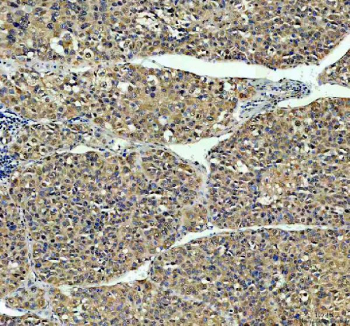 Immunohistochemical staining of NASP using anti-NASP antibody. NASP was detected in a paraffin-embedded section of human liver cancer tissue. Heat mediated antigen retrieval was performed in EDTA buffer (pH 8.0, epitope retrieval solution). The tissue section was blocked with 10% goat serum. The tissue section was then incubated with 2 ug/ml rabbit anti-NASP antibody overnight at 4oC. Peroxidase Conjugated Goat Anti-rabbit IgG was used as secondary antibody and incubated for 30 minutes at 37oC. The tissue section was developed using an HRP secondary and DAB substrate.