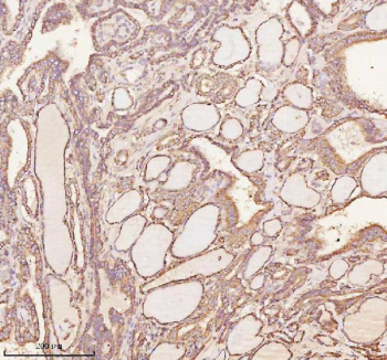 Immunohistochemical staining of NRTN using anti-NRTN antibody. NRTN was detected in a paraffin-embedded section of human thyroid papillary carcinoma tissue. Heat mediated antigen retrieval was performed in EDTA buffer (pH 8.0, epitope retrieval solution). The tissue section was blocked with 10% goat serum. The tissue section was then incubated with 2 ug/ml rabbit anti-NRTN antibody overnight at 4oC. Peroxidase Conjugated Goat Anti-rabbit IgG was used as secondary antibody and incubated for 30 minutes at 37oC. The tissue section was developed using an HRP secondary and DAB substrate.