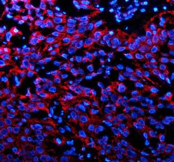 Immunofluorescent staining of P2RX1 using anti-P2RX1 antibody (red). P2RX1 was detected in a paraffin-embedded section of human bladder cancer tissue. Heat mediated antigen retrieval was performed in EDTA buffer (pH 8.0, epitope retrieval solution). The tissue section was blocked with 10% goat serum. The tissue section was then incubated with 5 ug/ml rabbit anti-P2RX1 antibody overnight at 4oC. Cy3 Conjugated Goat Anti-Rabbit IgG was used as secondary antibody at 1:500 dilution and incubated for 30 minutes at 37oC. The section was counterstained with DAPI nuclear stain (blue). Visualize using a fluorescence microscope and filter sets appropriate for the label used.