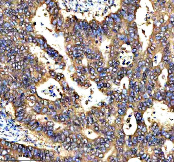 Immunohistochemical staining of RNF220 using anti-RNF220 antibody. RNF220 was detected in a paraffin-embedded section of human stomach cancer tissue. Heat mediated antigen retrieval was performed in EDTA buffer (pH 8.0, epitope retrieval solution). The tissue section was blocked with 10% goat serum. The tissue section was then incubated with 2 ug/ml rabbit anti-RNF220 antibody overnight at 4oC. Peroxidase Conjugated Goat Anti-rabbit IgG was used as secondary antibody and incubated for 30 minutes at 37oC. The tissue section was developed using an HRP secondary and DAB substrate.