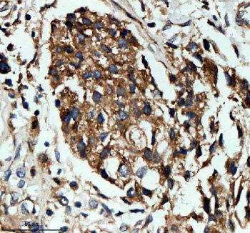 Immunohistochemical staining of NID1 using anti-NID1 antibody. NID1 was detected in a paraffin-embedded section of human breast cancer tissue. Heat mediated antigen retrieval was performed in EDTA buffer (pH 8.0, epitope retrieval solution). The tissue section was blocked with 10% goat serum. The tissue section was then incubated with 2 ug/ml rabbit anti-NID1 antibody overnight at 4oC. Peroxidase Conjugated Goat Anti-rabbit IgG was used as secondary antibody and incubated for 30 minutes at 37oC. The tissue section was developed using an HRP secondary and DAB substrate.