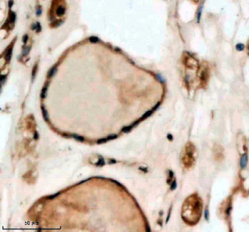 Immunohistochemical staining of SMARCAL1 using anti-SMARCAL1 antibody. SMARCAL1 was detected in a paraffin-embedded section of human thyroid cancer tissue. Heat mediated antigen retrieval was performed in EDTA buffer (pH 8.0, epitope retrieval solution). The tissue section was blocked with 10% goat serum. The tissue section was then incubated with 2 ug/ml rabbit anti-SMARCAL1 antibody overnight at 4oC. Peroxidase Conjugated Goat Anti-rabbit IgG was used as secondary antibody and incubated for 30 minutes at 37oC. The tissue section was developed using an HRP secondary and DAB substrate.