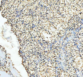 Immunohistochemical staining of RHOT2 using anti-RHOT2 antibody. RHOT2 was detected in a paraffin-embedded section of human renal cancer tissue. Heat mediated antigen retrieval was performed in EDTA buffer (pH 8.0, epitope retrieval solution). The tissue section was blocked with 10% goat serum. The tissue section was then incubated with 2 ug/ml rabbit anti-RHOT2 antibody overnight at 4oC. Peroxidase Conjugated Goat Anti-rabbit IgG was used as secondary antibody and incubated for 30 minutes at 37oC. The tissue section was developed using an HRP secondary and DAB substrate.
