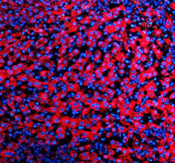 Immunofluorescent staining of SIGIRR using anti-SIGIRR antibody (red). SIGIRR was detected in a paraffin-embedded section of human liver cancer tissue. Heat mediated antigen retrieval was performed in EDTA buffer (pH 8.0, epitope retrieval solution). The tissue section was blocked with 10% goat serum. The tissue section was then incubated with 5 ug/ml rabbit anti-SIGIRR antibody overnight at 4oC. Cy3 Conjugated Goat Anti-Rabbit IgG was used as secondary antibody at 1:500 dilution and incubated for 30 minutes at 37oC. The section was counterstained with DAPI nuclear stain (blue). Visualize using a fluorescence microscope and filter sets appropriate for the label used.