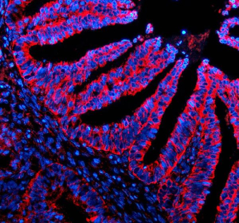 Immunofluorescent staining of SIGIRR using anti-SIGIRR antibody (red). SIGIRR was detected in a paraffin-embedded section of human endometrial cancer tissue. Heat mediated antigen retrieval was performed in EDTA buffer (pH 8.0, epitope retrieval solution). The tissue section was blocked with 10% goat serum. The tissue section was then incubated with 5 ug/ml rabbit anti-SIGIRR antibody overnight at 4oC. Cy3 Conjugated Goat Anti-Rabbit IgG was used as secondary antibody at 1:500 dilution and incubated for 30 minutes at 37oC. The section was counterstained with DAPI nuclear stain (blue). Visualize using a fluorescence microscope and filter sets appropriate for the label used.