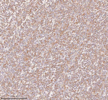 Immunohistochemical staining of SLC14A1 using anti-SLC14A1 antibody. SLC14A1 was detected in a paraffin-embedded section of human melanoma tissue. Heat mediated antigen retrieval was performed in EDTA buffer (pH 8.0, epitope retrieval solution). The tissue section was blocked with 10% goat serum. The tissue section was then incubated with 2 ug/ml rabbit anti-SLC14A1 antibody overnight at 4oC. Peroxidase Conjugated Goat Anti-rabbit IgG was used as secondary antibody and incubated for 30 minutes at 37oC. The tissue section was developed using an HRP secondary and DAB substrate.