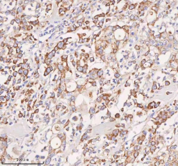 Immunohistochemical staining of SLC14A1 using anti-SLC14A1 antibody. SLC14A1 was detected in a paraffin-embedded section of human pancreatic cancer tissue. Heat mediated antigen retrieval was performed in EDTA buffer (pH 8.0, epitope retrieval solution). The tissue section was blocked with 10% goat serum. The tissue section was then incubated with 2 ug/ml rabbit anti-SLC14A1 antibody overnight at 4oC. Peroxidase Conjugated Goat Anti-rabbit IgG was used as secondary antibody and incubated for 30 minutes at 37oC. The tissue section was developed using an HRP secondary and DAB substrate.