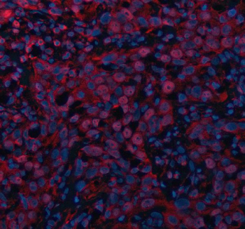 Immunofluorescent staining of MAML3 using anti-MAML3 antibody (red). MAML3 was detected in a paraffin-embedded section of human bladder cancer tissue. Heat mediated antigen retrieval was performed in EDTA buffer (pH 8.0, epitope retrieval solution). The tissue section was blocked with 10% goat serum. The tissue section was then incubated with 5 ug/ml rabbit anti-MAML3 antibody overnight at 4oC. Cy3 Conjugated Goat Anti-Rabbit IgG was used as secondary antibody at 1:500 dilution and incubated for 30 minutes at 37oC. The section was counterstained with DAPI nuclear stain (blue). Visualize using a fluorescence microscope and filter sets appropriate for the label used.