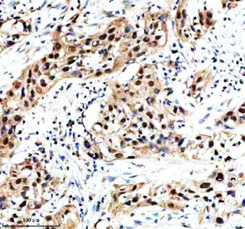 Immunohistochemical staining of MAML3 using anti-MAML3 antibody. MAML3 was detected in a paraffin-embedded section of human bladder cancer tissue. Heat mediated antigen retrieval was performed in EDTA buffer (pH 8.0, epitope retrieval solution). The tissue section was blocked with 10% goat serum. The tissue section was then incubated with 2 ug/ml rabbit anti-MAML3 antibody overnight at 4oC. Peroxidase Conjugated Goat Anti-rabbit IgG was used as secondary antibody and incubated for 30 minutes at 37oC. The tissue section was developed using an HRP secondary and DAB substrate.
